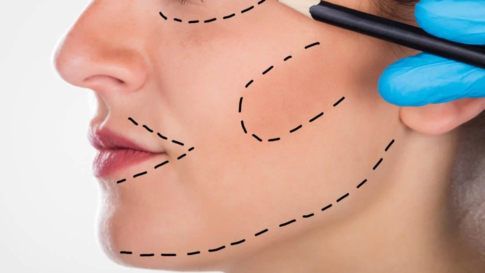 Lipofilling facial Ana de la concepcion