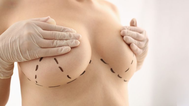 LIPOFILLING